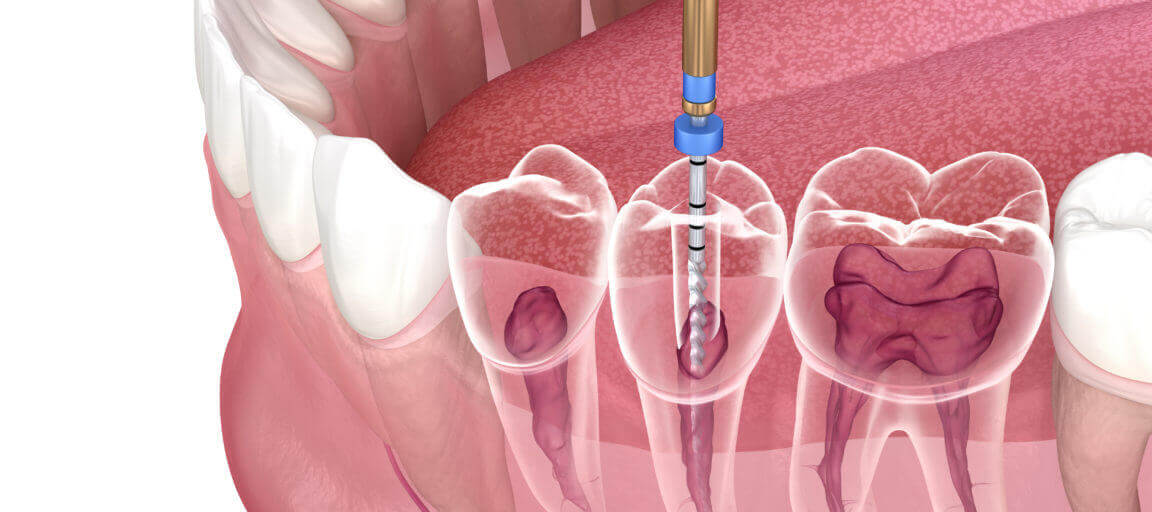 Making Endodontic Diagnosis More Accurate - PankeyGram